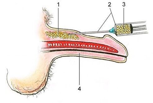 Injection of adipose tissue under the skin of the penis